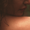Skin Rash: Symptoms, Causes and Treatment