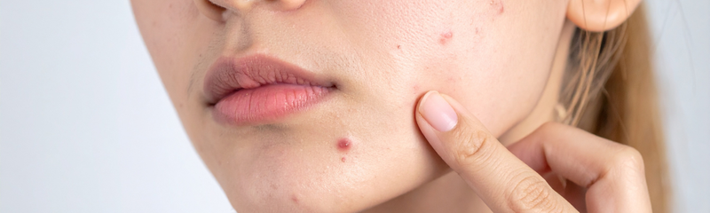 Hormonelle Akne: Ausbrüche verstehen und behandeln, die mit Hormonen zusammenhängen