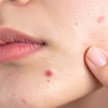 Hormonal acne: understanding and managing breakouts linked to hormones